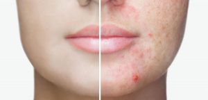 Lire la suite à propos de l’article Différence entre les probiotiques et une approche préventive de l’acné.