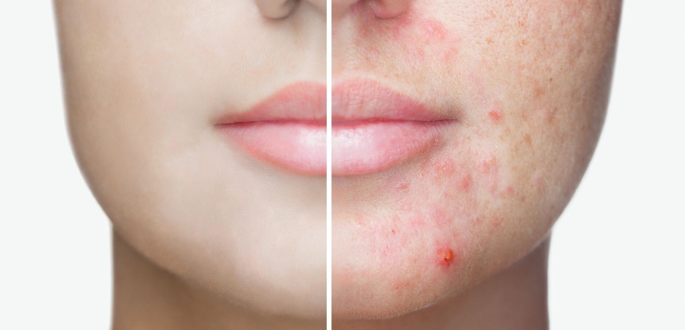 You are currently viewing Différence entre les probiotiques et une approche préventive de l’acné.